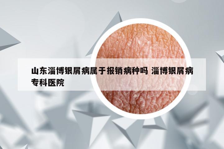 山东淄博银屑病属于报销病种吗 淄博银屑病专科医院