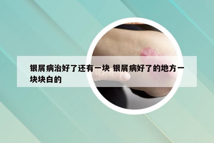 银屑病治好了还有一块 银屑病好了的地方一块块白的