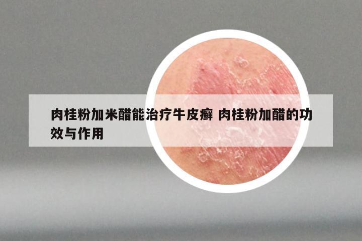肉桂粉加米醋能治疗牛皮癣 肉桂粉加醋的功效与作用