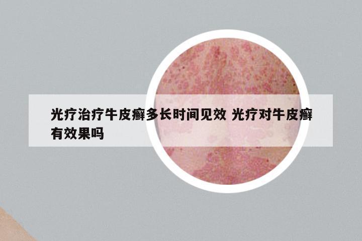 光疗治疗牛皮癣多长时间见效 光疗对牛皮癣有效果吗