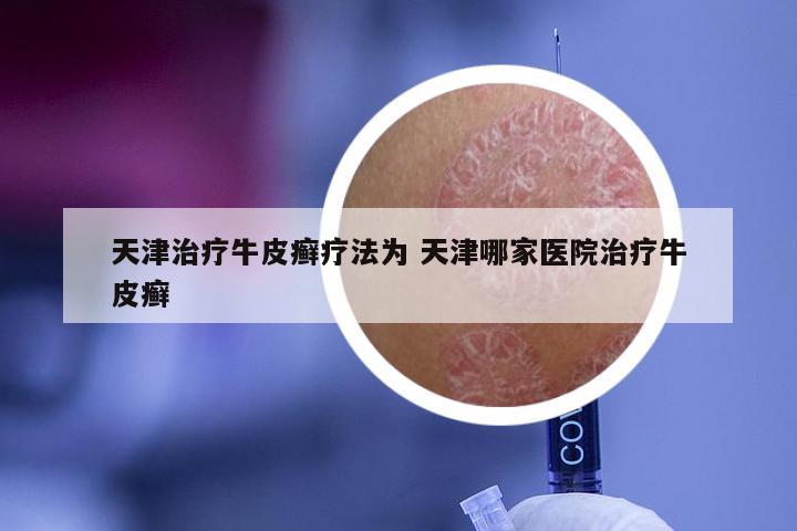 天津治疗牛皮癣疗法为 天津哪家医院治疗牛皮癣