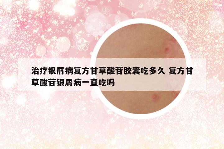 治疗银屑病复方甘草酸苷胶囊吃多久 复方甘草酸苷银屑病一直吃吗
