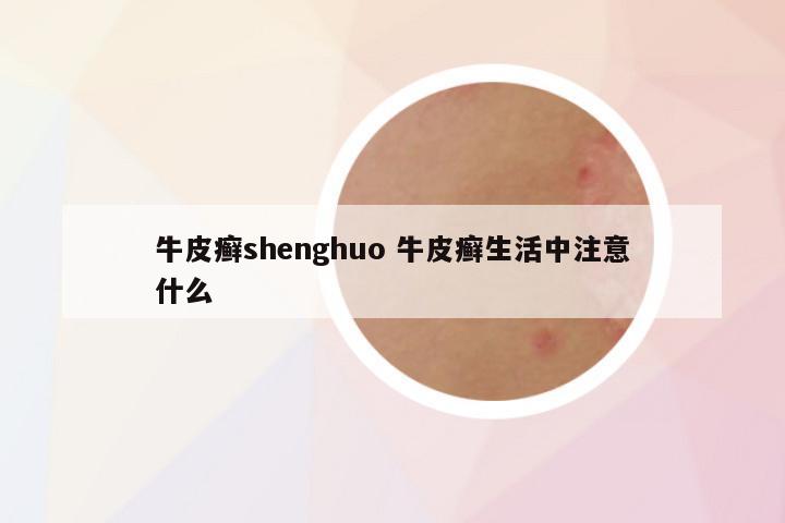 牛皮癣shenghuo 牛皮癣生活中注意什么
