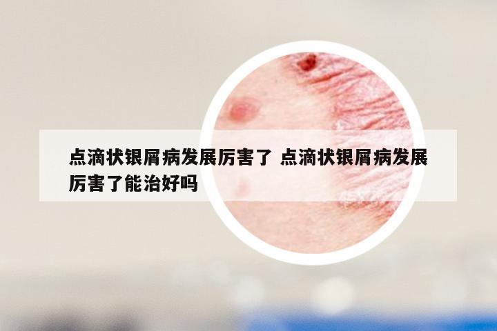 点滴状银屑病发展厉害了 点滴状银屑病发展厉害了能治好吗
