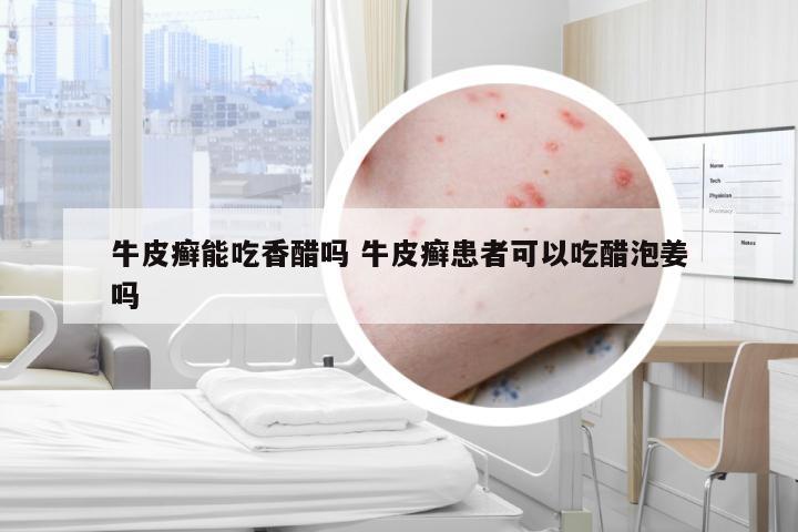 牛皮癣能吃香醋吗 牛皮癣患者可以吃醋泡姜吗