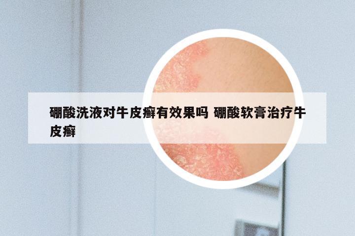 硼酸洗液对牛皮癣有效果吗 硼酸软膏治疗牛皮癣