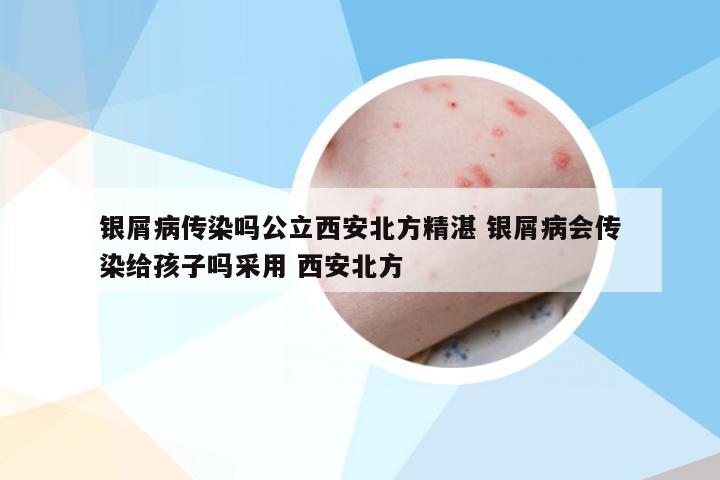 银屑病传染吗公立西安北方精湛 银屑病会传染给孩子吗采用 西安北方