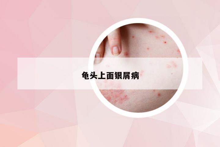龟头上面银屑病