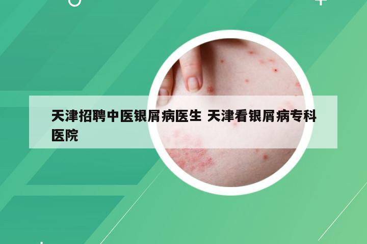 天津招聘中医银屑病医生 天津看银屑病专科医院