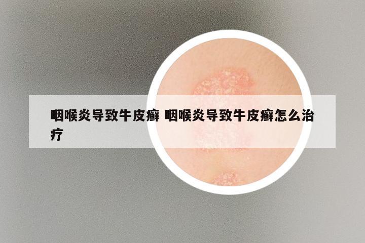 咽喉炎导致牛皮癣 咽喉炎导致牛皮癣怎么治疗