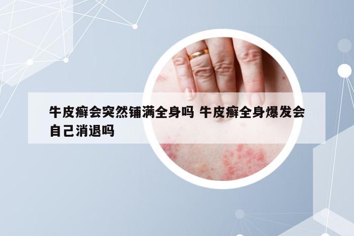 牛皮癣会突然铺满全身吗 牛皮癣全身爆发会自己消退吗