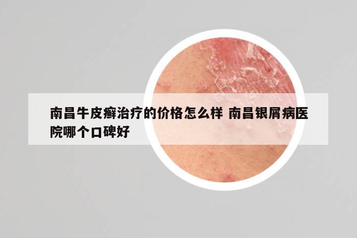 南昌牛皮癣治疗的价格怎么样 南昌银屑病医院哪个口碑好
