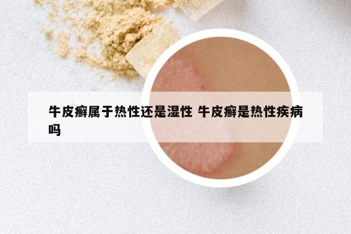牛皮癣属于热性还是湿性 牛皮癣是热性疾病吗