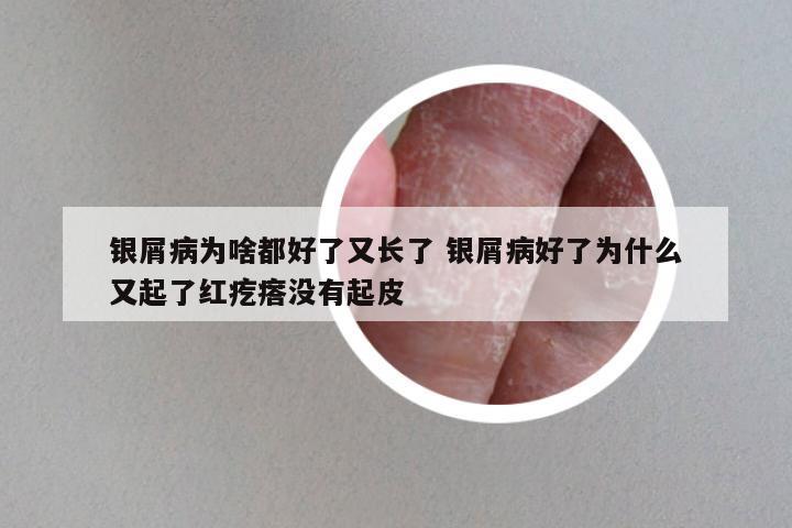 银屑病为啥都好了又长了 银屑病好了为什么又起了红疙瘩没有起皮
