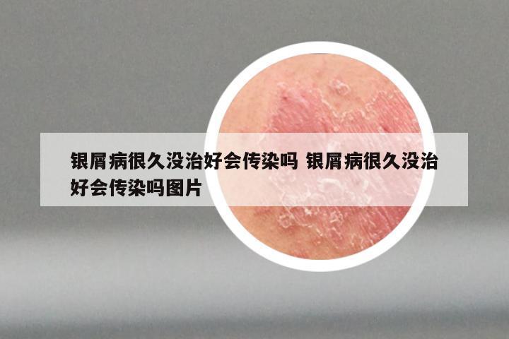 银屑病很久没治好会传染吗 银屑病很久没治好会传染吗图片