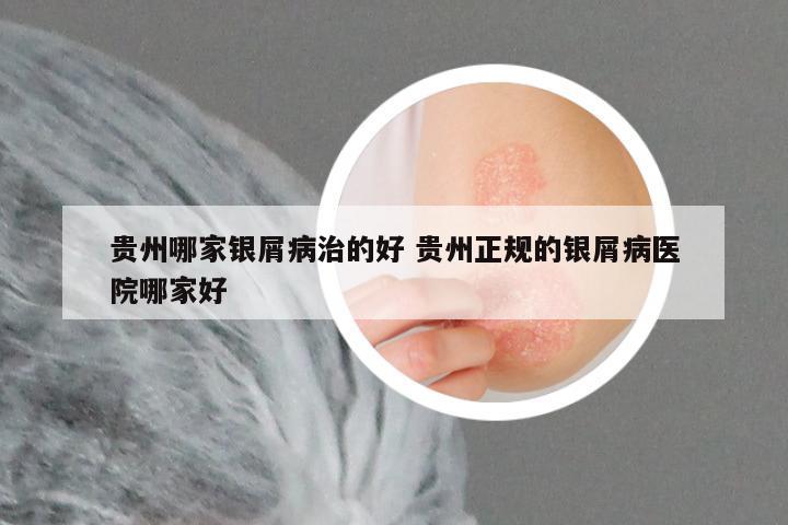 贵州哪家银屑病治的好 贵州正规的银屑病医院哪家好