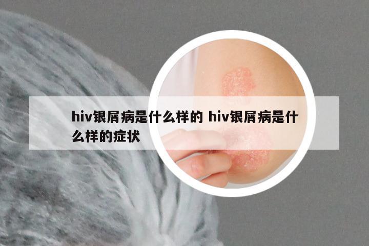 hiv银屑病是什么样的 hiv银屑病是什么样的症状