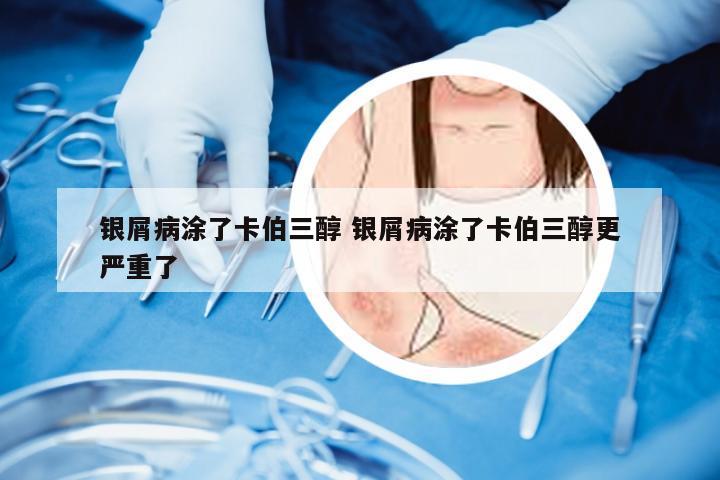 银屑病涂了卡伯三醇 银屑病涂了卡伯三醇更严重了