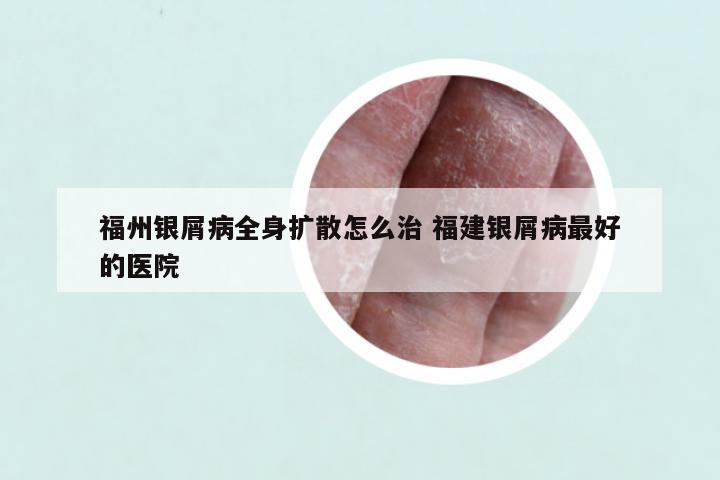 福州银屑病全身扩散怎么治 福建银屑病最好的医院