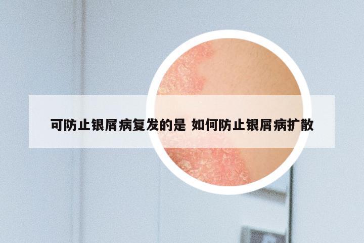可防止银屑病复发的是 如何防止银屑病扩散