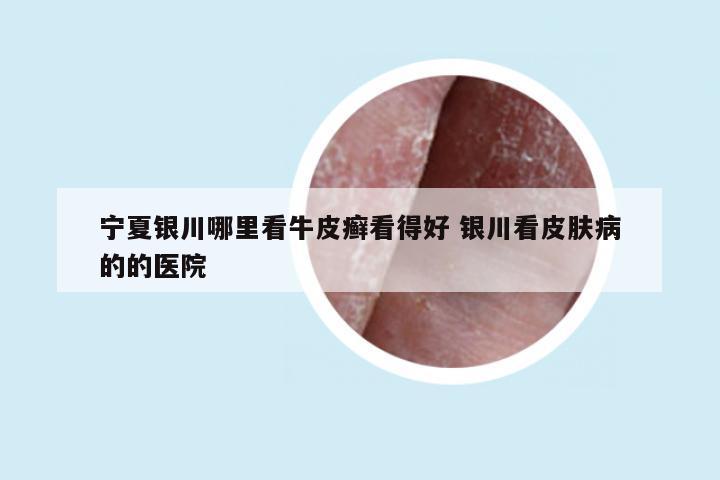 宁夏银川哪里看牛皮癣看得好 银川看皮肤病的的医院