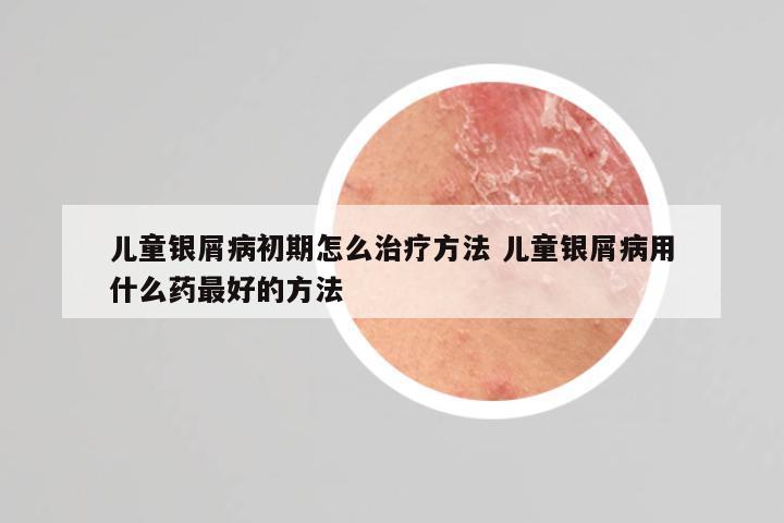 儿童银屑病初期怎么治疗方法 儿童银屑病用什么药最好的方法