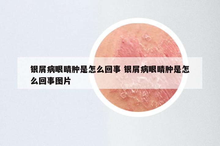 银屑病眼睛肿是怎么回事 银屑病眼睛肿是怎么回事图片