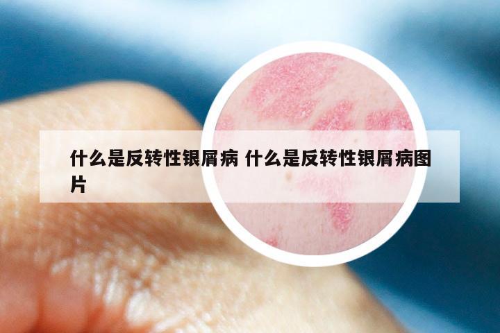 什么是反转性银屑病 什么是反转性银屑病图片