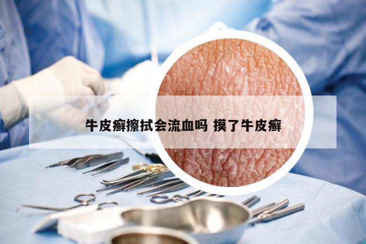 牛皮癣擦拭会流血吗 摸了牛皮癣