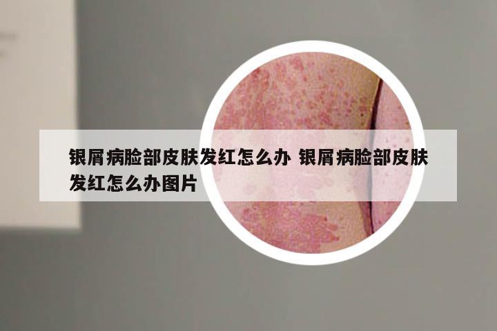 银屑病脸部皮肤发红怎么办 银屑病脸部皮肤发红怎么办图片