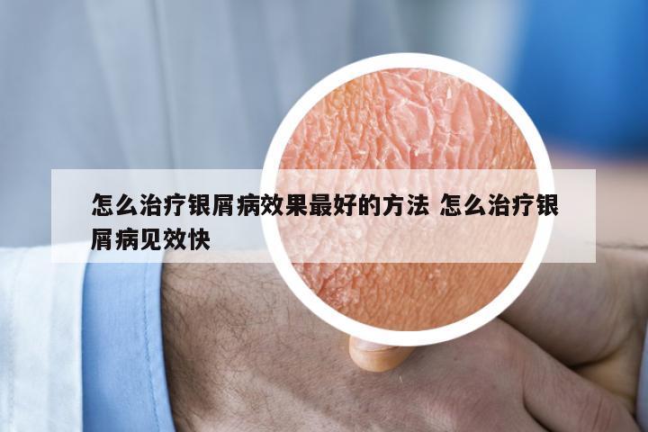 怎么治疗银屑病效果最好的方法 怎么治疗银屑病见效快