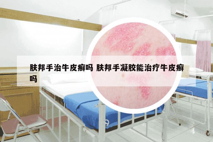 肤邦手治牛皮癣吗 肤邦手凝胶能治疗牛皮癣吗