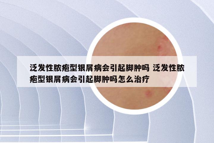 泛发性脓疱型银屑病会引起脚肿吗 泛发性脓疱型银屑病会引起脚肿吗怎么治疗