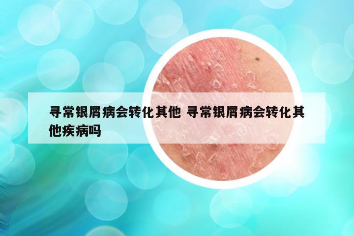 寻常银屑病会转化其他 寻常银屑病会转化其他疾病吗