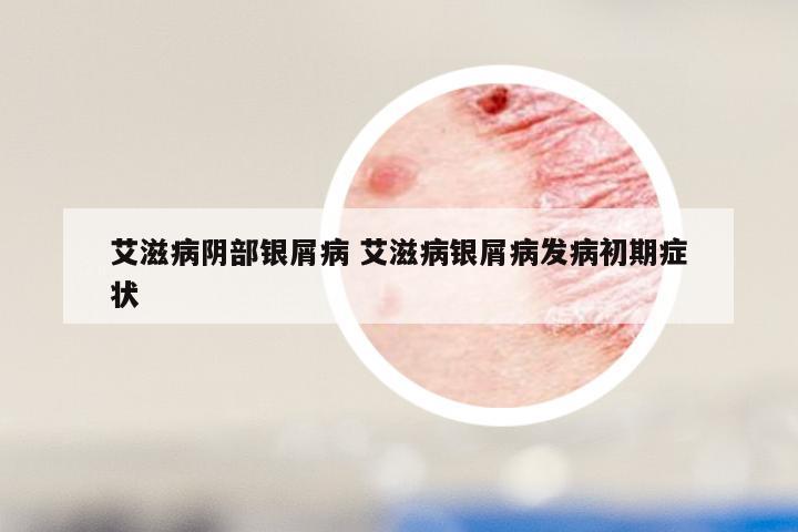 艾滋病阴部银屑病 艾滋病银屑病发病初期症状