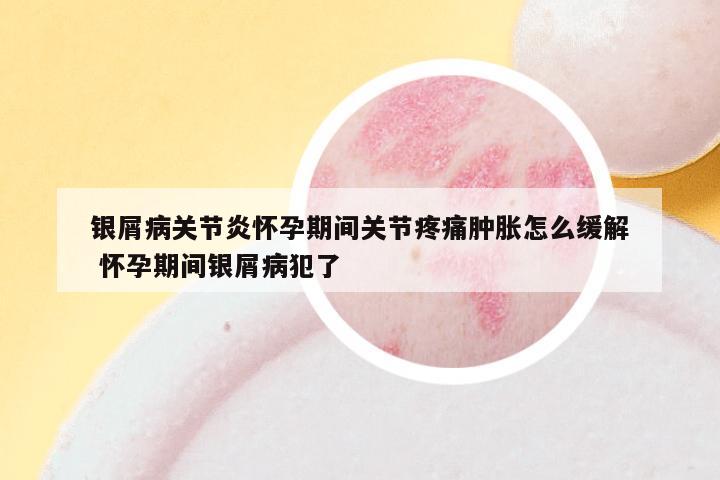 银屑病关节炎怀孕期间关节疼痛肿胀怎么缓解 怀孕期间银屑病犯了
