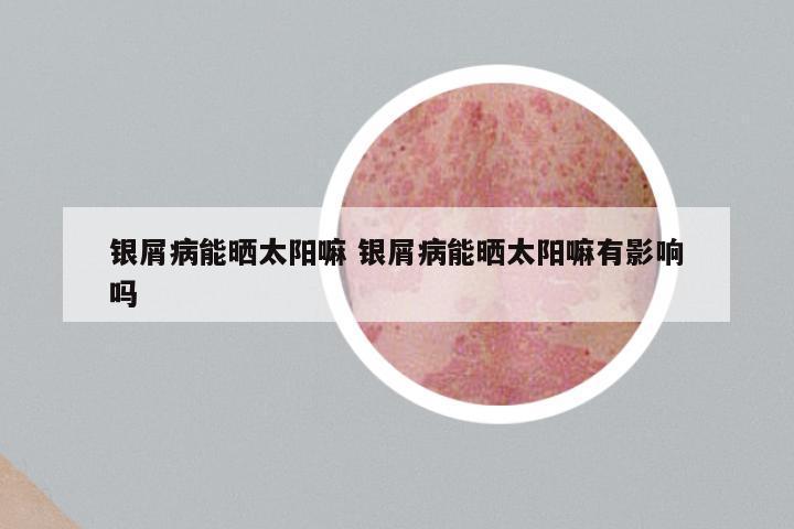 银屑病能晒太阳嘛 银屑病能晒太阳嘛有影响吗