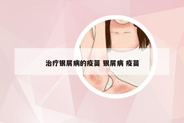 治疗银屑病的疫苗 银屑病 疫苗