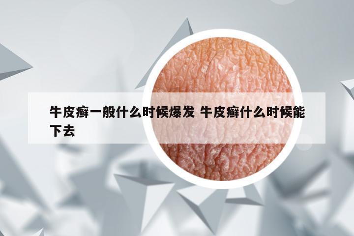 牛皮癣一般什么时候爆发 牛皮癣什么时候能下去