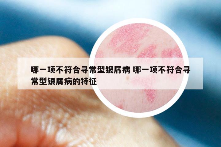 哪一项不符合寻常型银屑病 哪一项不符合寻常型银屑病的特征