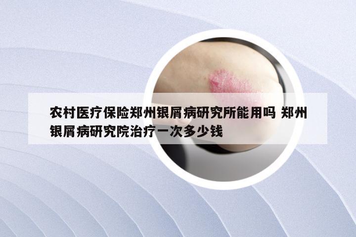 农村医疗保险郑州银屑病研究所能用吗 郑州银屑病研究院治疗一次多少钱