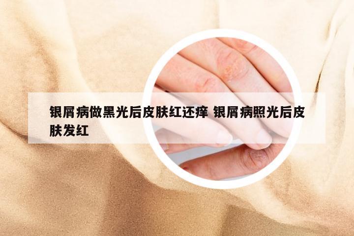 银屑病做黑光后皮肤红还痒 银屑病照光后皮肤发红