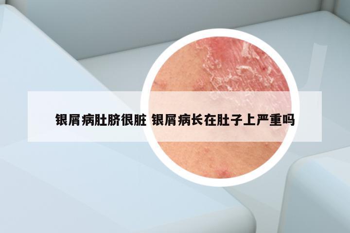 银屑病肚脐很脏 银屑病长在肚子上严重吗