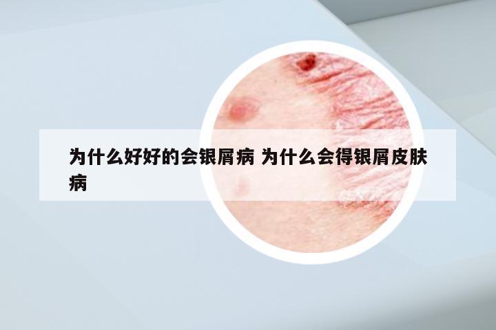 为什么好好的会银屑病 为什么会得银屑皮肤病