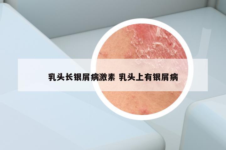 乳头长银屑病激素 乳头上有银屑病