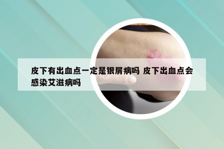 皮下有出血点一定是银屑病吗 皮下出血点会感染艾滋病吗