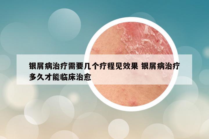 银屑病治疗需要几个疗程见效果 银屑病治疗多久才能临床治愈