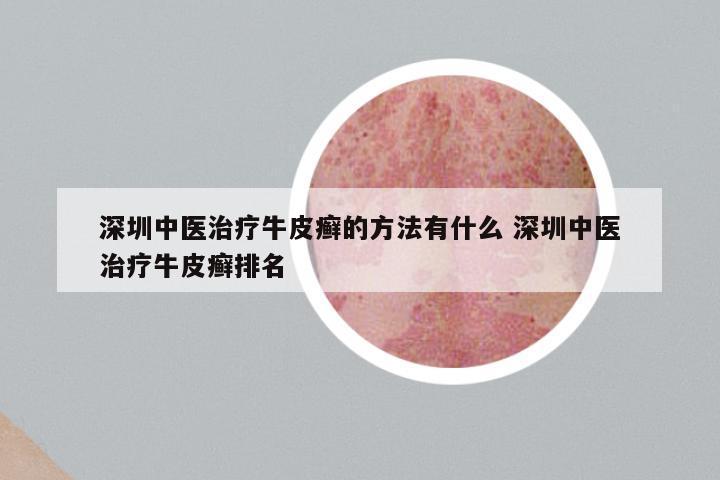 深圳中医治疗牛皮癣的方法有什么 深圳中医治疗牛皮癣排名