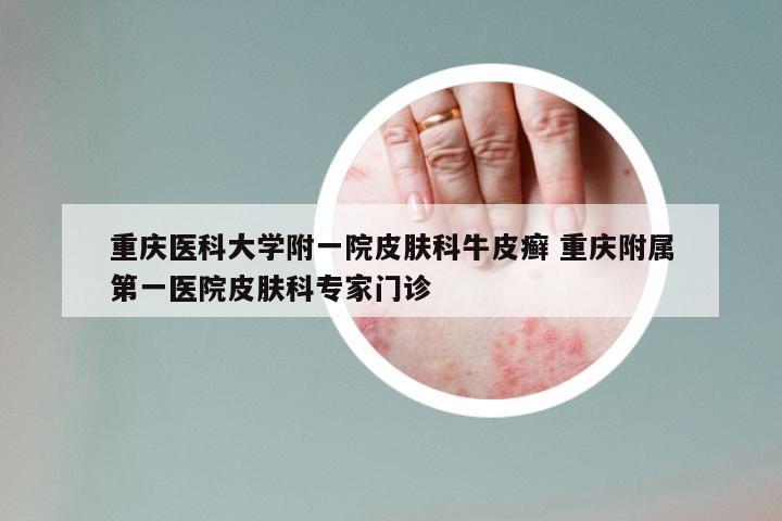 重庆医科大学附一院皮肤科牛皮癣 重庆附属第一医院皮肤科专家门诊