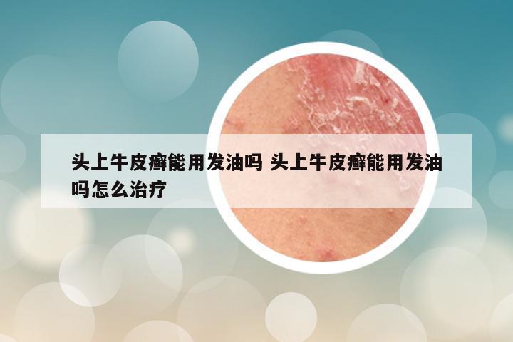 头上牛皮癣能用发油吗 头上牛皮癣能用发油吗怎么治疗